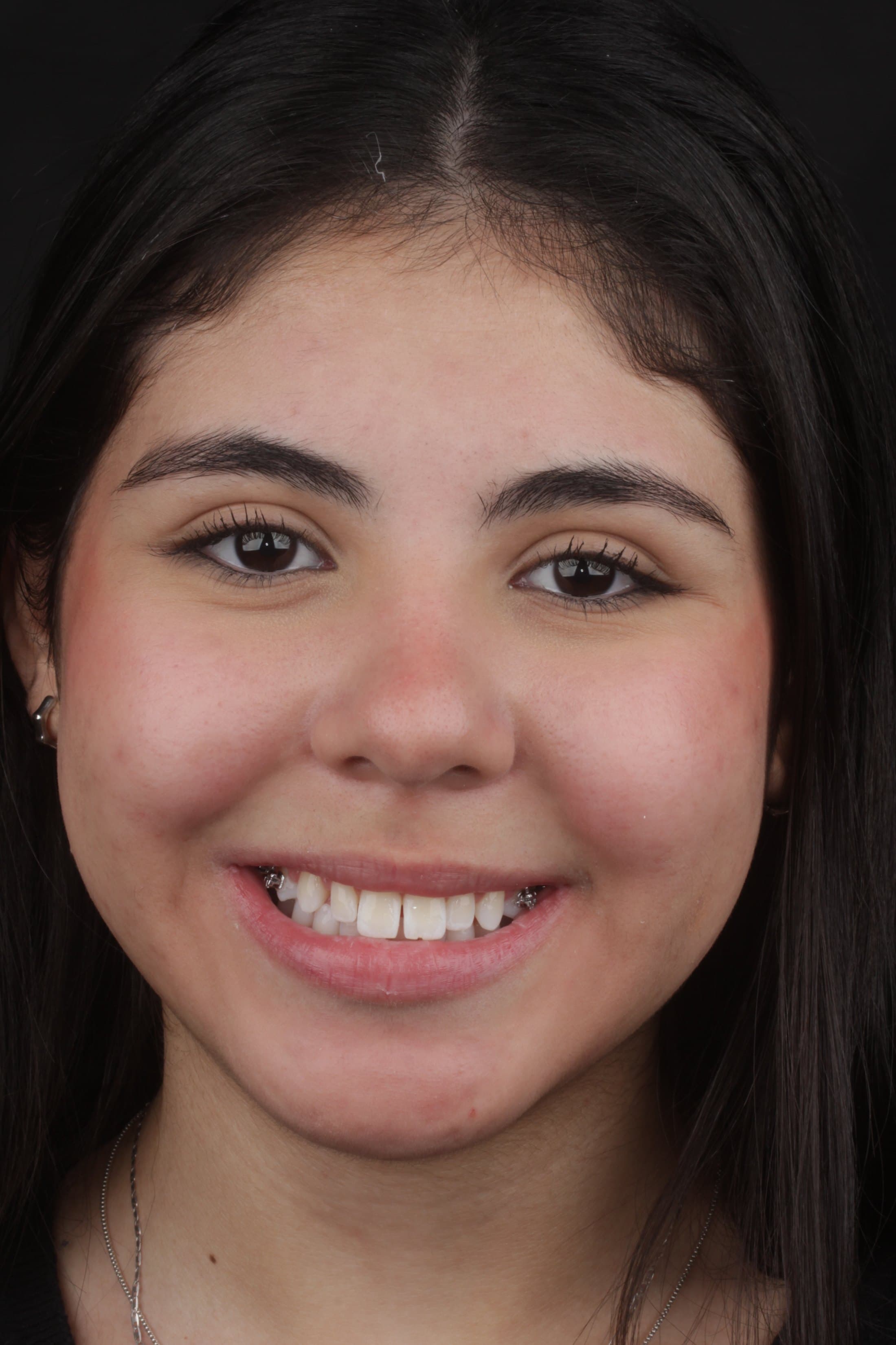 Clinical case 4 by Dr. Jaqueline Amadeu Merino — Before